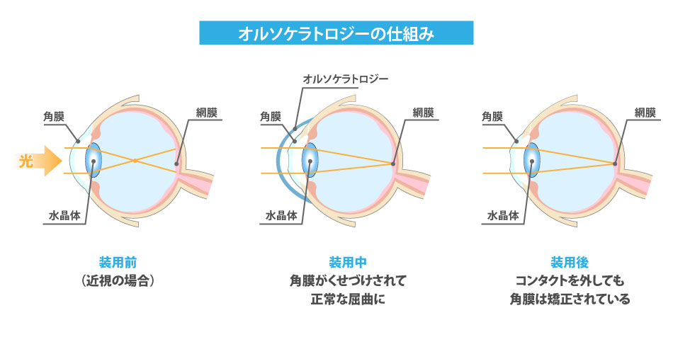 オルソケラトロジーのイメージ写真